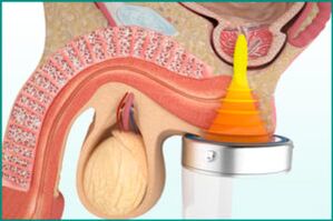Prostatitis