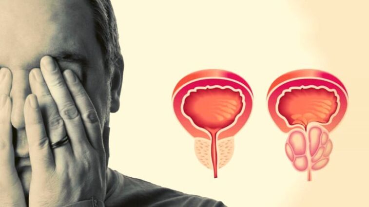 Man has prostatitis