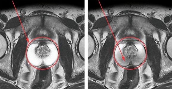 Normal prostate (left) and inflammation of the prostate with prostatitis (right)